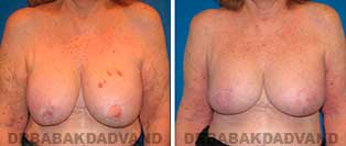 Revision Breast. Before & After Photos. 67 year old woman - front view