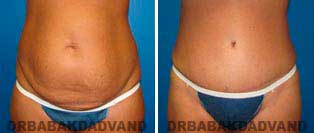 Tummy Tuck: Before and After Photos. 41 year old female - front view