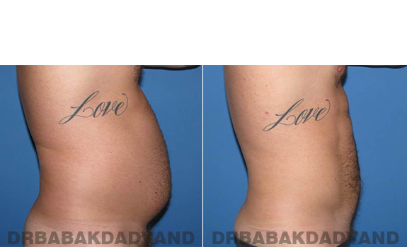 Before and After Photos. Vaser Liposaction