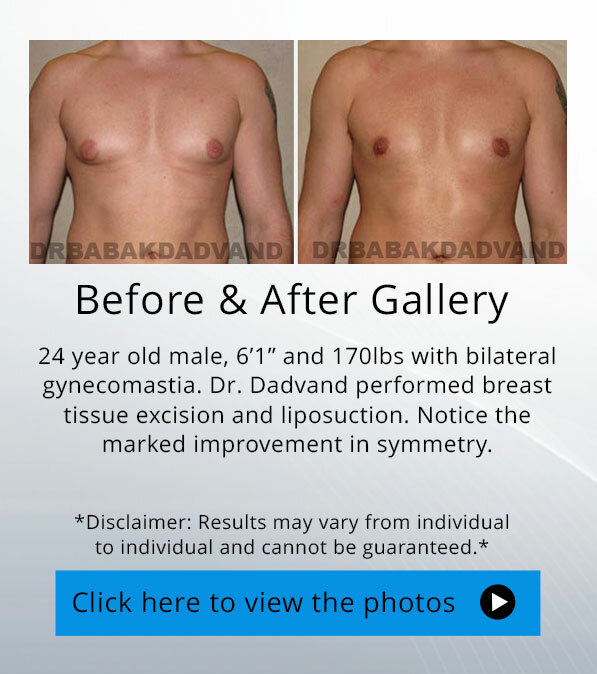 Gynecomastia. Before and After Photos.