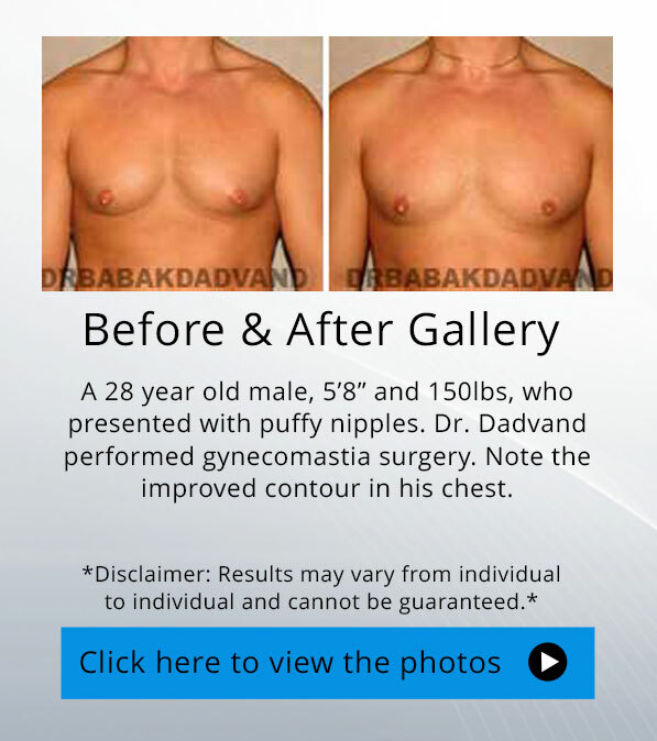 Gynecomastia. Before and After Photos. 27 year old male. Frontal view