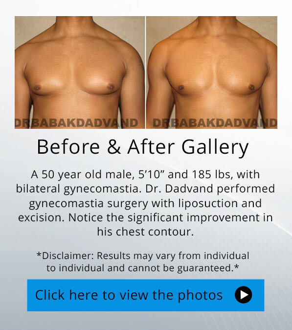 Gynecomastia. Before and After Photos