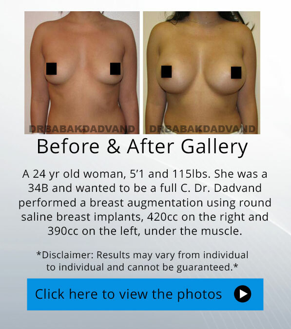 Breast Augmentation. Before and After photos. 24 yr woman - front view