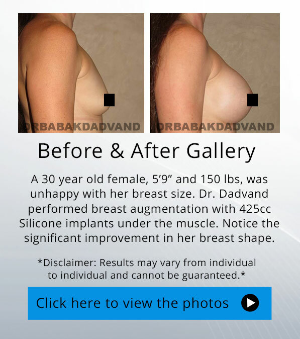 Breast Augmentation. Before and After photos. 26 yr woman - right side view