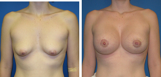 tuberous breast photo 2