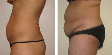 Best Mini Tummy Tuck Candidate