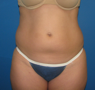 Best Candidates for Tummy Tuck after photo