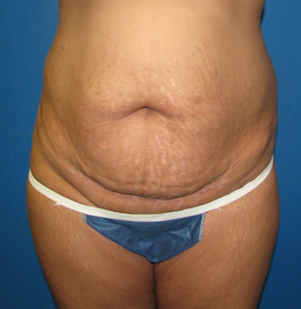 Best Candidates for Tummy Tuck before photo