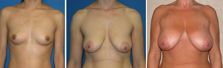 breast surgery patients photo