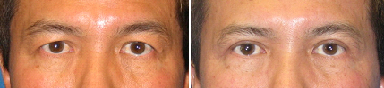 Upper Eyelid Surgery before and after photo