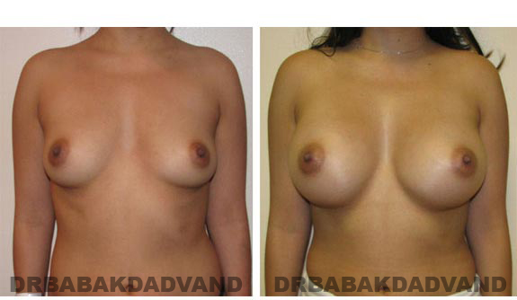Before and After.Photos.Breast-Augmentation: Female, front view