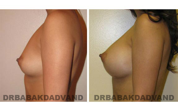 Before and After.Photos.Breast-Augmentation: Female, left side view