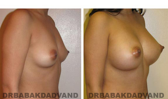 Before and After.Photos.Breast-Augmentation: Female, right side, oblique view