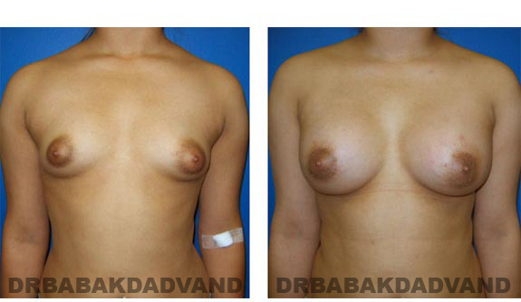Before and After Photos. Breast-Augmentation:  - Woman, front view