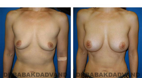 Before and After Photos. Breast-Augmentation: - front view 41 yr old woman