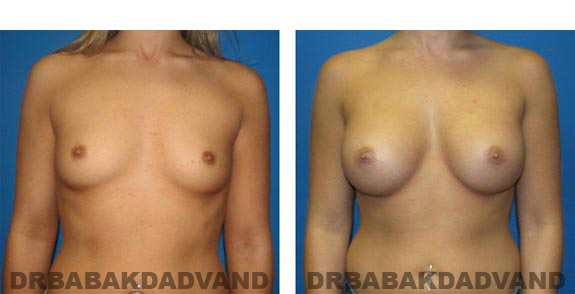 Before and After Photos. Breast-Augmentation: - front view 23 yr old woman