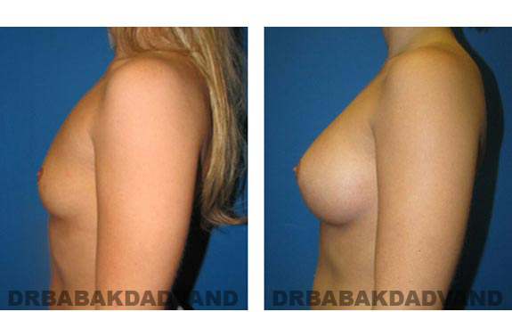 Before and After Photos. Breast-Augmentation: - left side view 23 yr old woman
