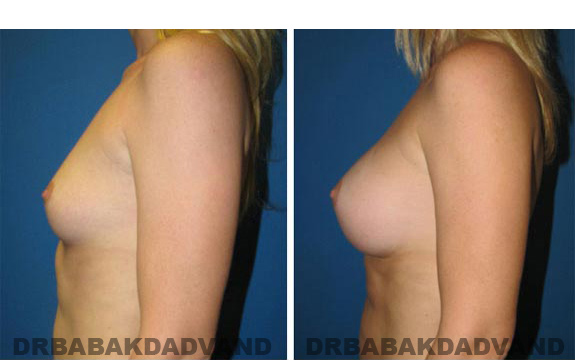 Before and After Photos. Breast-Augmentation: - left side view 31 yr old woman
