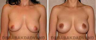 Breast Augmentation. Before & After Photos. 45 year old female frontal view