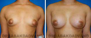 Breast Augmentation. Before & After Photos. 21 year old female frontal view