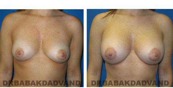 Before and After Photos. Breast-Augmentation: - front view 32 yr old woman