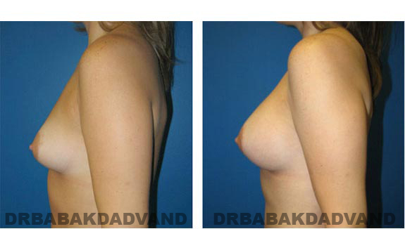 Before and After Photos. Breast-Augmentation: - left side view 32 yr old woman
