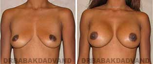 Breast Augmentation. Before & After Photos. 24 year old female frontal view