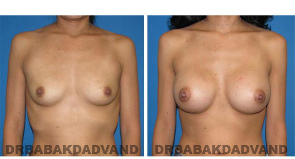 Before & After.Photos.Breast-Augmentation: Woman, front view
