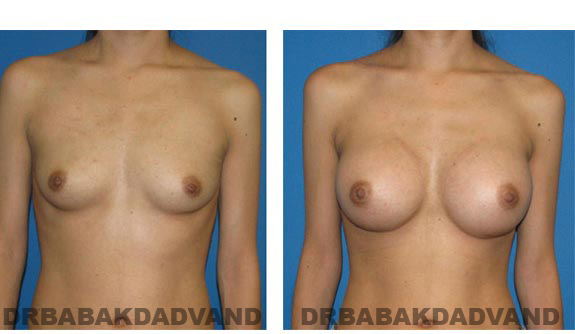 Before and After.Photos.Breast-Augmentation: Woman, front view