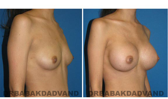 Before and After.Photos.Breast-Augmentation: Woman, right side, oblique view