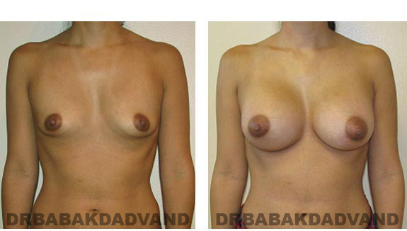 Breast-Augmentation. Before and After Photos - Female, front view