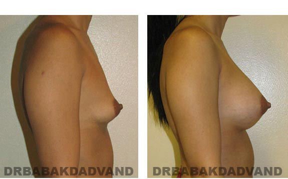Breast-Augmentation. Before and After Photos - Female, right side view