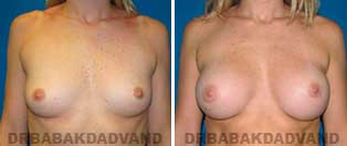 Breast Augmentation. Before & After Photos. 31 year old woman frontal view