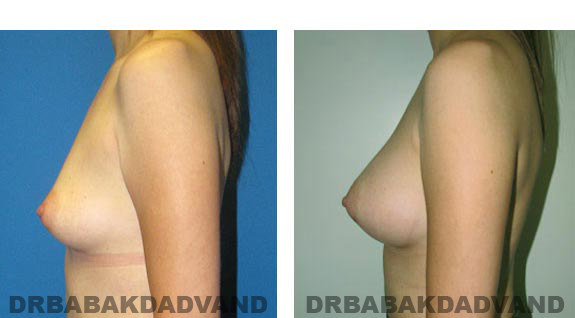 Before and After Photos. Breast-Augmentation: - 34 year old woman, left side view