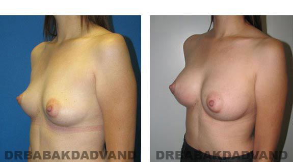 Before and After Photos. Breast-Augmentation: - 34 year old woman, left side oblique view