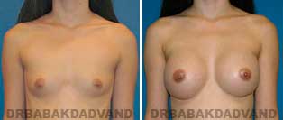 Breast Augmentation. Before & After Photos. 29 year old woman frontal view
