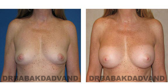 Before and After Photos. Breast-Augmentation: - 44 year old woman, front view