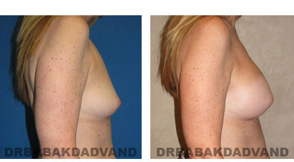 Before and After Photos. Breast-Augmentation: - 44 year old woman, right side view