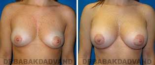 Breast Augmentation. Before & After Photos. 32 year old woman frontal view