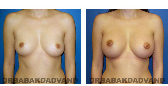 Before & After Photos. Breast-Augmentation: - 29 year old woman, front view