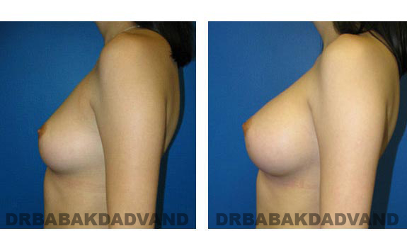 Before & After Photos. Breast-Augmentation: - 29 year old woman, left side view