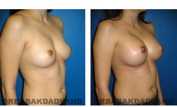 Before & After Photos. Breast-Augmentation: - 29 year old woman, right side oblique view