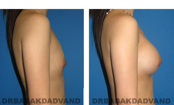 Before & After Photos. Breast-Augmentation: - 23 year old woman, right side view