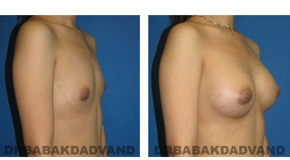 Before & After Photos. Breast-Augmentation: - 23 year old woman, right side oblique view