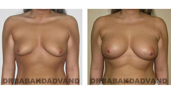Before & After Photos. Breast-Augmentation: - 22 year old woman, front view