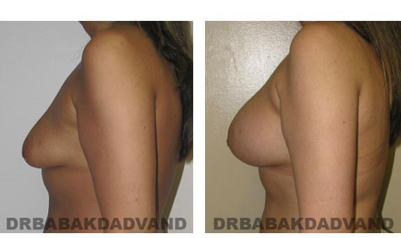 Before & After Photos. Breast-Augmentation: - 22 year old woman, left side view