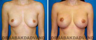 Breast Augmentation. Before & After Photos. 29 year old woman - frontal view