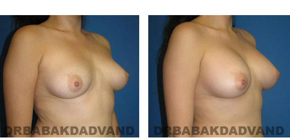 Before & After Photos. Breast-Augmentation: - 27 year old woman, right side oblique view