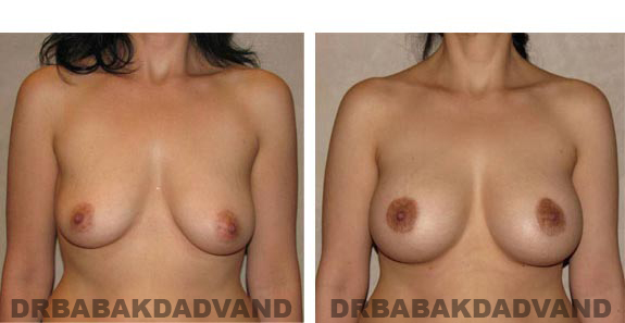 Before and After Photos. Breast-Breastlift: - 45 year old female, front view