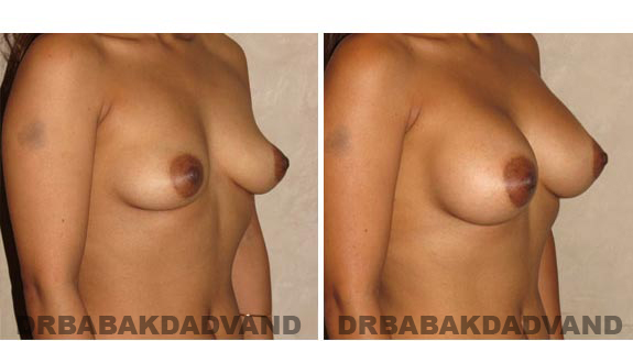 Breast-Augmentation. Before & After Photos - Woman, right side, oblique view